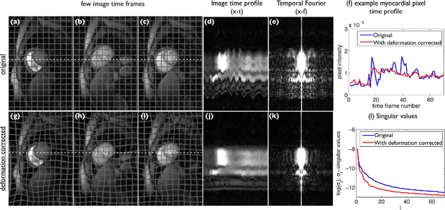 Figure 1 for Deformation corrected compressed sensing (DC-CS): a novel framework for accelerated dynamic MRI