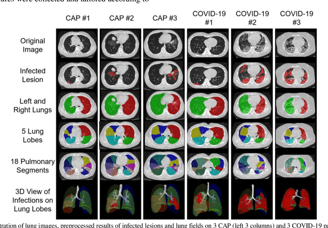 Figure 1 for Large-Scale Screening of COVID-19 from Community Acquired Pneumonia using Infection Size-Aware Classification