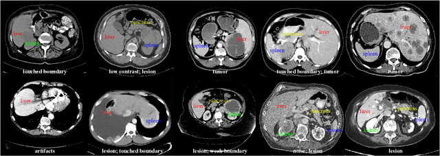 Figure 1 for AbdomenCT-1K: Is Abdominal Organ Segmentation A Solved Problem?