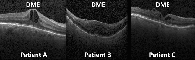 Figure 1 for Patient Aware Active Learning for Fine-Grained OCT Classification