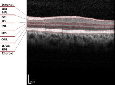 Figure 4 for 3D Automatic Segmentation Method for Retinal Optical Coherence Tomography Volume Data Using Boundary Surface Enhancement