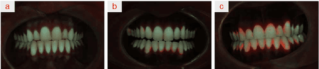 Figure 4 for Classification of Quantitative Light-Induced Fluorescence Images Using Convolutional Neural Network