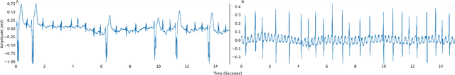 Figure 4 for ArNet-ECG: Deep Learning for the Detection of Atrial Fibrillation from the Raw Electrocardiogram