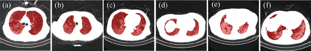 Figure 4 for DuCN: Dual-children Network for Medical Diagnosis and Similar Case Recommendation towards COVID-19