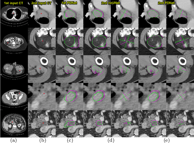 Figure 3 for Lesion Segmentation and RECIST Diameter Prediction via Click-driven Attention and Dual-path Connection