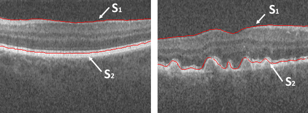 Figure 1 for Simultaneous Multiple Surface Segmentation Using Deep Learning