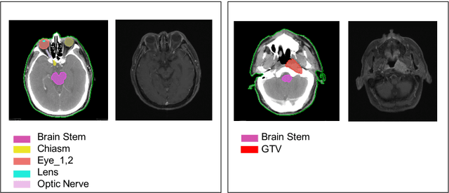 Figure 3 for Organ At Risk Segmentation with Multiple Modality