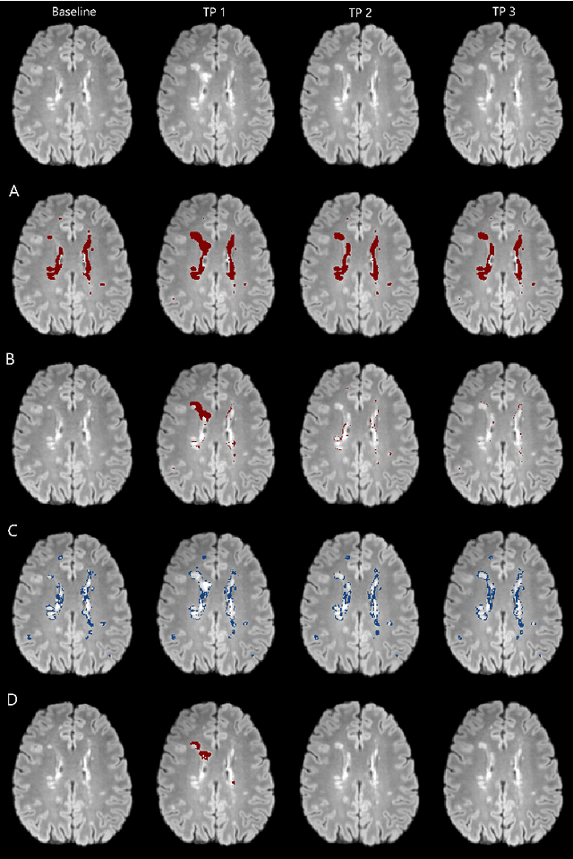 Figure 3 for Automatic detection of lesion load change in Multiple Sclerosis using convolutional neural networks with segmentation confidence