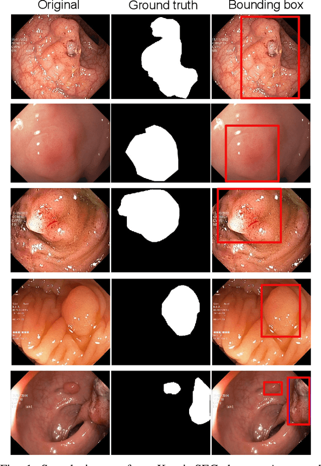 Figure 1 for Real-Time Polyp Detection, Localisation and Segmentation in Colonoscopy Using Deep Learning