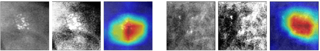 Figure 2 for Effect of Random Histogram Equalization on Breast Calcification Analysis Using Deep Learning