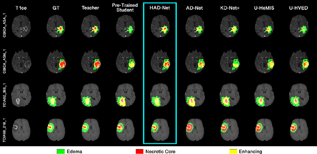 Figure 3 for HAD-Net: A Hierarchical Adversarial Knowledge Distillation Network for Improved Enhanced Tumour Segmentation Without Post-Contrast Images