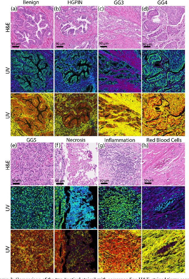 Figure 4 for Prostate cancer histopathology with label-free multispectral deep UV microscopy quantifies phenotypes of tumor grade and aggressiveness