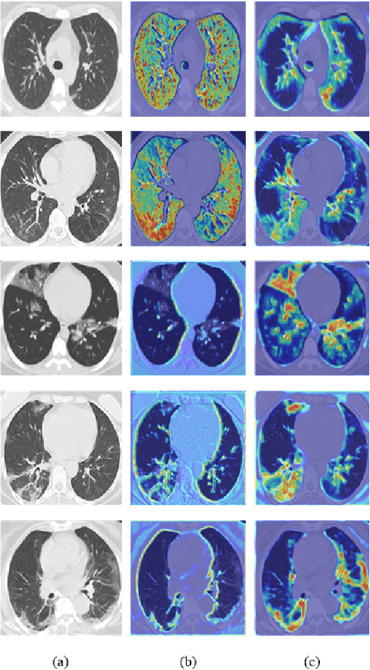 Figure 4 for Multi-scale alignment and Spatial ROI Module for COVID-19 Diagnosis