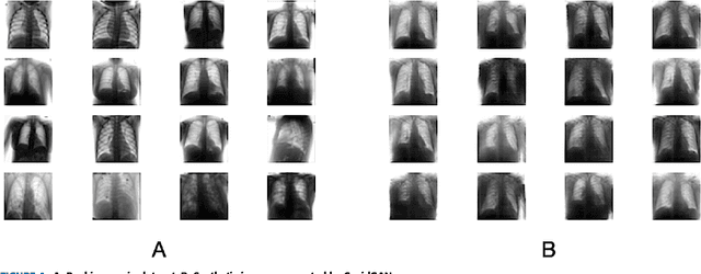 Figure 4 for CovidGAN: Data Augmentation Using Auxiliary Classifier GAN for Improved Covid-19 Detection