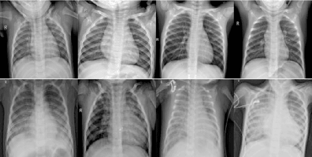 Figure 1 for An Adaptive and Altruistic PSO-based Deep Feature Selection Method for Pneumonia Detection from Chest X-Rays