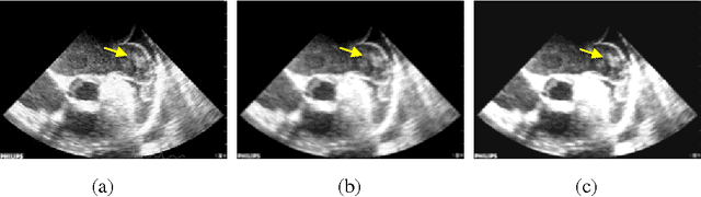 Figure 4 for An algorithm for Left Atrial Thrombi detection using Transesophageal Echocardiography