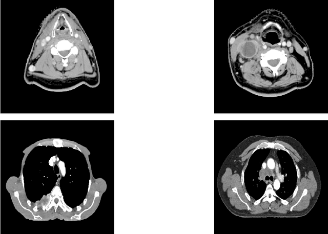 Figure 1 for A Quantitative Comparison between Shannon and Tsallis Havrda Charvat Entropies Applied to Cancer Outcome Prediction