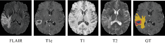 Figure 1 for Feature-enhanced Generation and Multi-modality Fusion based Deep Neural Network for Brain Tumor Segmentation with Missing MR Modalities