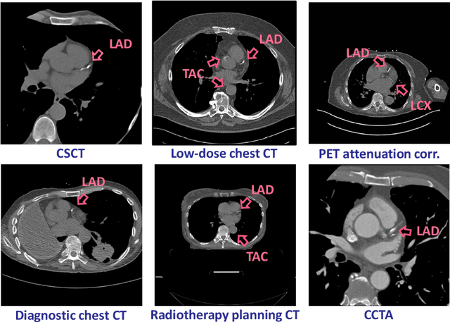 Figure 3 for AI for Calcium Scoring