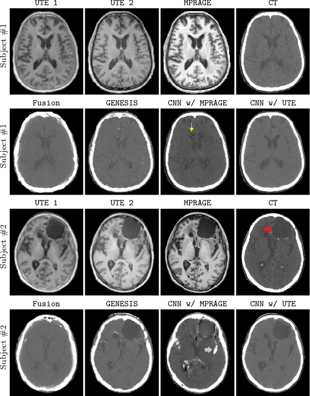 Figure 3 for Synthesizing CT from Ultrashort Echo-Time MR Images via Convolutional Neural Networks
