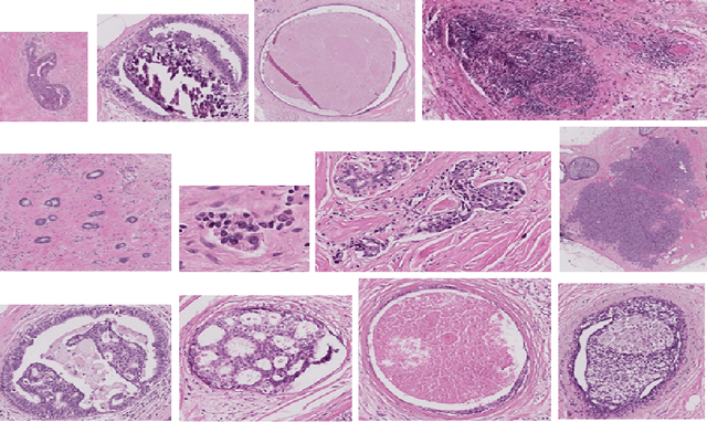 Figure 1 for Bag of Visual Words with Deep Features -- Patch Classification Model for Limited Dataset of Breast Tumours