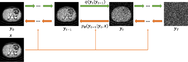 Figure 1 for Low-Dose CT Using Denoising Diffusion Probabilistic Model for 20$\times$ Speedup