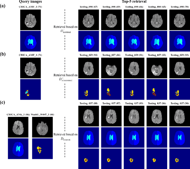 Figure 3 for Decomposing Normal and Abnormal Features of Medical Images for Content-based Image Retrieval