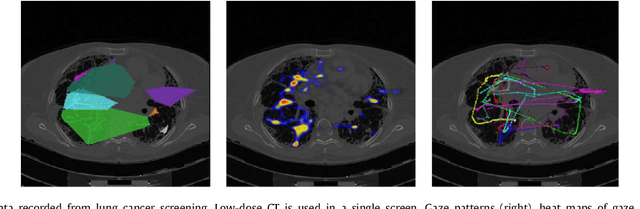 Figure 4 for A Collaborative Computer Aided Diagnosis (C-CAD) System with Eye-Tracking, Sparse Attentional Model, and Deep Learning