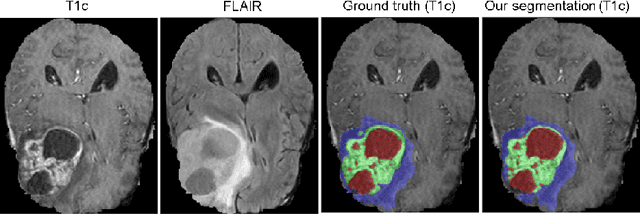Figure 3 for Brain Tumor Segmentation and Radiomics Survival Prediction: Contribution to the BRATS 2017 Challenge