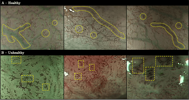 Figure 1 for Interpretable Fully Convolutional Classification of Intrapapillary Capillary Loops for Real-Time Detection of Early Squamous Neoplasia