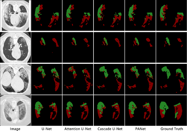 Figure 4 for Prior Attention Network for Multi-Lesion Segmentation in Medical Images