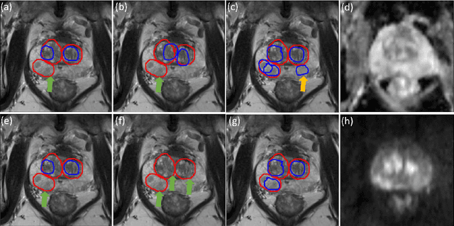 Figure 4 for Controlling False Positive/Negative Rates for Deep-Learning-Based Prostate Cancer Detection on Multiparametric MR images