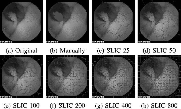 Figure 2 for Superpixel Based Segmentation and Classification of Polyps in Wireless Capsule Endoscopy