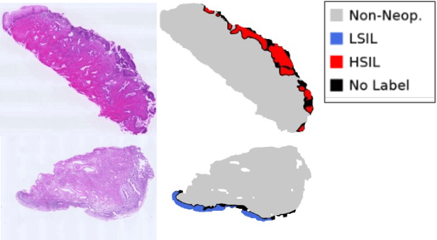 Figure 1 for Patch-Based Cervical Cancer Segmentation using Distance from Boundary of Tissue