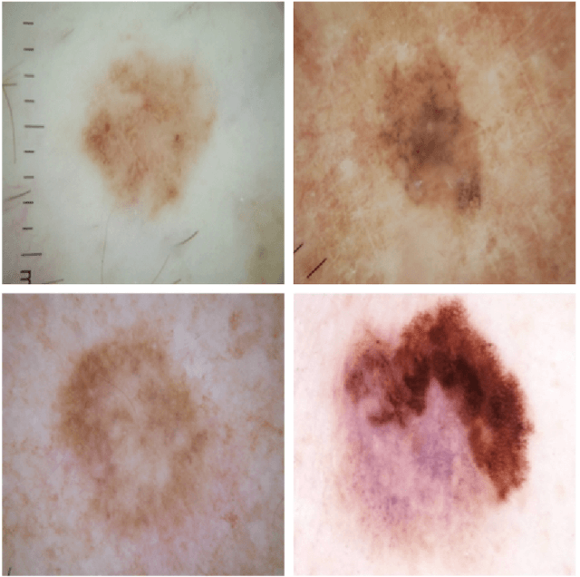 Figure 1 for Skin Lesion Analysis toward Melanoma Detection: A Challenge at the International Symposium on Biomedical Imaging 2016, hosted by the International Skin Imaging Collaboration