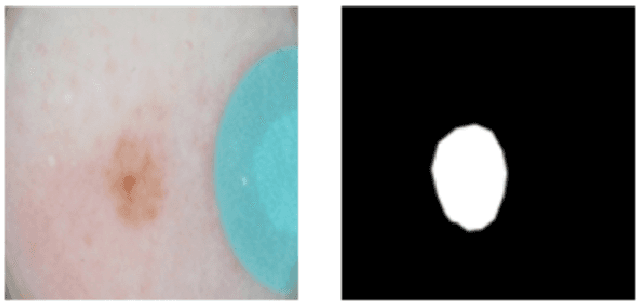 Figure 2 for Skin Lesion Analysis Toward Melanoma Detection: A Challenge at the 2017 International Symposium on Biomedical Imaging , Hosted by the International Skin Imaging Collaboration