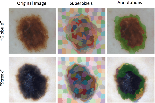 Figure 3 for Skin Lesion Analysis Toward Melanoma Detection: A Challenge at the 2017 International Symposium on Biomedical Imaging , Hosted by the International Skin Imaging Collaboration