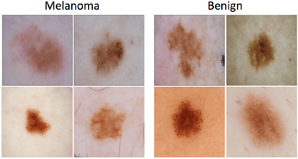 Figure 4 for Skin Lesion Analysis toward Melanoma Detection: A Challenge at the International Symposium on Biomedical Imaging 2016, hosted by the International Skin Imaging Collaboration
