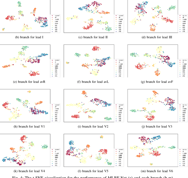 Figure 4 for MLBF-Net: A Multi-Lead-Branch Fusion Network for Multi-Class Arrhythmia Classification Using 12-Lead ECG