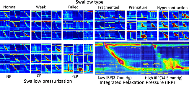 Figure 3 for A multi-stage machine learning model on diagnosis of esophageal manometry