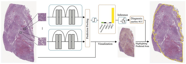 Figure 2 for Development and Evaluation of a Deep Neural Network for Histologic Classification of Renal Cell Carcinoma on Biopsy and Surgical Resection Slides