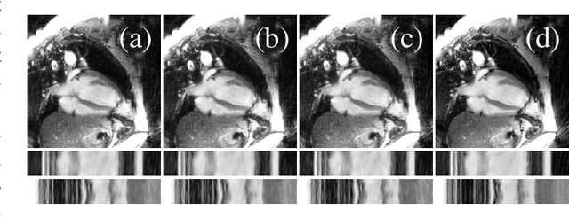 Figure 2 for Spatio-Temporal Deep Learning-Based Undersampling Artefact Reduction for 2D Radial Cine MRI with Limited Data