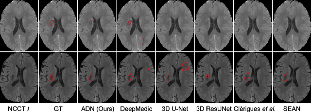 Figure 4 for Asymmetry Disentanglement Network for Interpretable Acute Ischemic Stroke Infarct Segmentation in Non-Contrast CT Scans