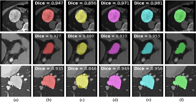 Figure 3 for Weakly-Supervised Lesion Segmentation on CT Scans using Co-Segmentation