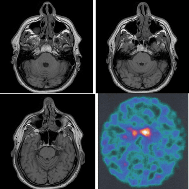 Figure 1 for Predicting Parkinson's Disease using Latent Information extracted from Deep Neural Networks