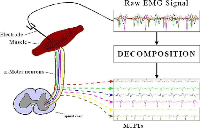 Figure 1 for Generative Multiple-Instance Learning Models For Quantitative Electromyography