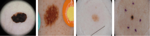 Figure 4 for Deep Learning Based Decision Support for Medicine -- A Case Study on Skin Cancer Diagnosis