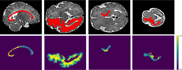 Figure 1 for Learning to segment fetal brain tissue from noisy annotations
