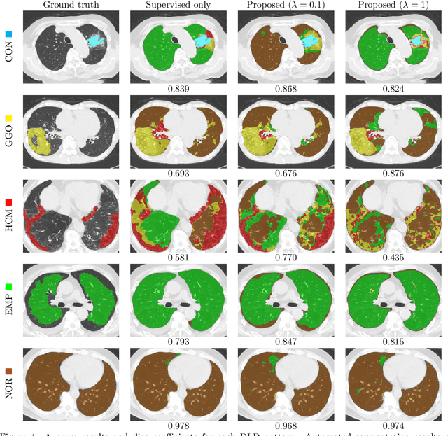 Figure 4 for Weak Supervision in Convolutional Neural Network for Semantic Segmentation of Diffuse Lung Diseases Using Partially Annotated Dataset