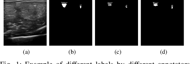 Figure 1 for Weakly- and Semi-Supervised Probabilistic Segmentation and Quantification of Ultrasound Needle-Reverberation Artifacts to Allow Better AI Understanding of Tissue Beneath Needles
